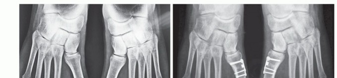 Illustration 33 for Mastering the Biplanar Distal Chevron for Effective Bunion Surgery