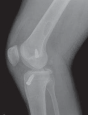 Illustration 26 for Cruciate Ligament Repair: Definitive Guide to Treatment & Recovery