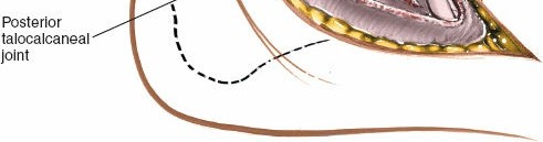 Illustration 12 for Mastering the Lateral Approach to the Posterior Talocalcaneal Joint