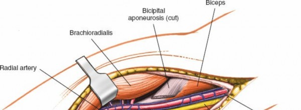 Illustration 80 for Mastering Elbow Approaches: Applied Surgical Anatomy for Precision