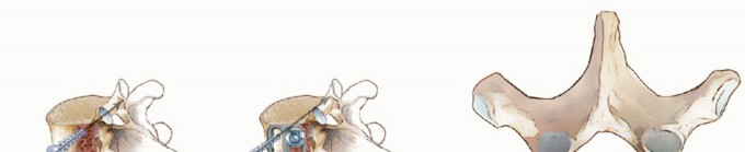 Illustration 7 for Anterior Thoracic Corpectomy: Decompression, Stabilization, Fusion