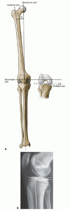 Achieve Lasting Pain Relief with Cemented Total Knee Arthroplasty