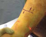 Illustration 36 for Optimal Nailing of the Tibia: Techniques for Challenging Fractures