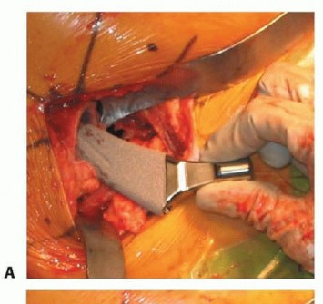Illustration 38 for Hemiarthroplasty of the Hip: Indications & Types Explained