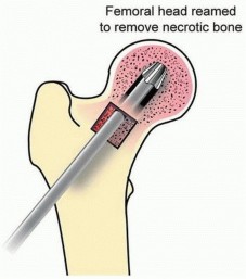 Illustration 6 for Head-Sparing for Osteonecrosis of the Femoral: Preserve Your Hip
