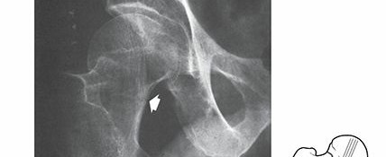Comprehensive Management of Femoral Neck Fractures: An Operative Guide