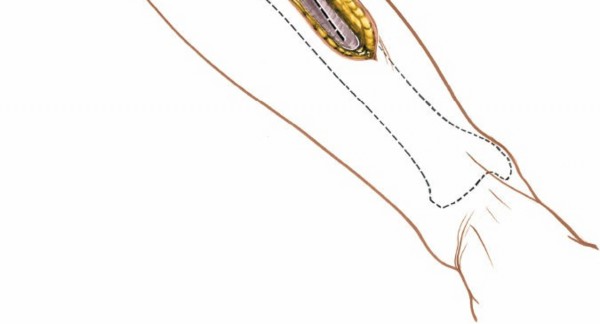 Illustration 62 for Surgical Access: Mastering the Tibia's Surface & Fibula Approaches