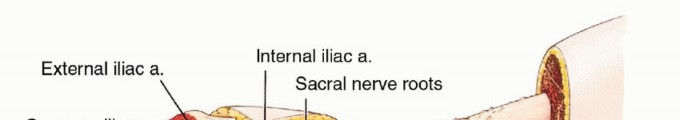Illustration 30 for Anterior Flap Hemipelvectomy: Leveraging fig tech fig for Difficult Tumors