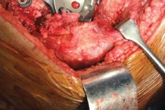 Illustration 38 for Optimizing Arthroplasty in Acute Fractures: Octopus System