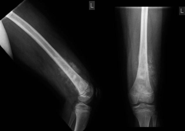 Examination Question Osteosarcoma: Your Guide to Oral Success