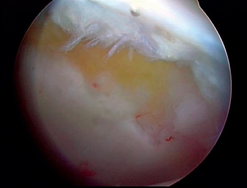 Illustration 19 for Essential Hip Arthroscopy Techniques for Optimal Outcomes
