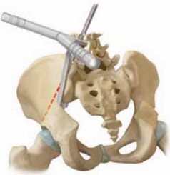 Illustration 11 for Optimizing Instrumentation for Neuromuscular Scoliosis
