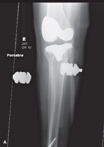 Illustration of painful total knee - Dr. Mohammed Hutaif