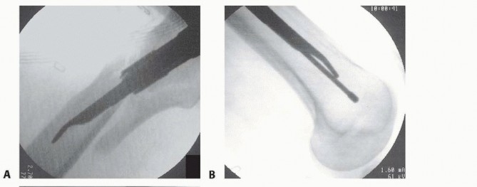 Illustration 24 for Achieve Optimal Femoral Head Fixation with Cephalomedullary Nailing