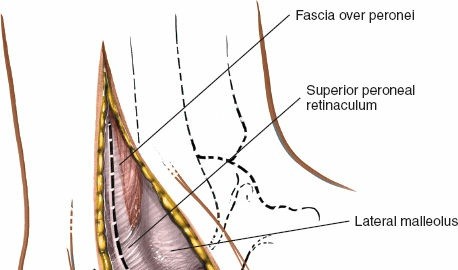 Illustration 120 for Optimized Approaches to the Dorsum of the Foot & Ankle