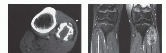 Illustration 4 for Beyond Amputation: The Type I Resection in Fibular Tumor Surgery