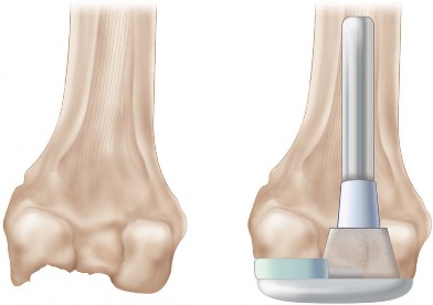 Illustration 12 for Understand Augments: The Role of Metal Augments in Arthroplasty