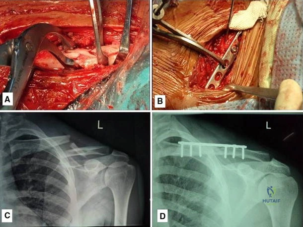 CLAVICAL
