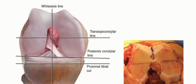 Illustration 24 for Achieve Lasting Pain Relief with Cemented Total Knee Arthroplasty