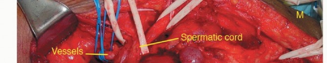 Illustration 8 for Optimizing Resection: An Overview of Surgical Approaches for Space Sarcomas