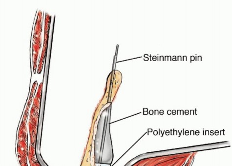 Illustration 44 for Pelvic Metastasis Surgery: A Component of the Utilitarian Approach