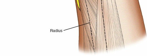 Illustration 12 for Key Approaches for External Fixation: Humerus, Radius, Ulna, Wrist