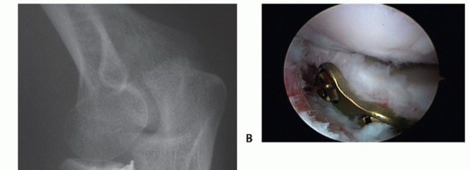 Illustration 46 for Radial Head & Neck Fractures: Mastering ORIF for Best Results