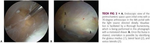 Illustration 112 for Periarticular Arthroscopy: Addressing Medius & Minimus Tears