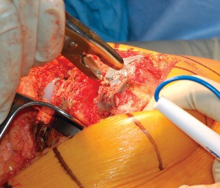 Illustration 36 for Mastering Gap Balancing in Revision TKA: Avoid Common Pitfalls