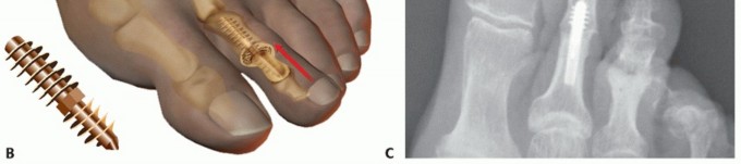 Illustration 40 for Hammer Toe Correction: Understanding the Extensor Digitorum Longus