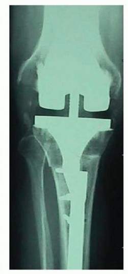 Illustration 15 for Bone Loss Bone Grafting for Challenging Tibial Defects