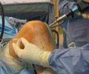 Illustration 7 for Cruciate Ligament Repair: Definitive Guide to Treatment & Recovery