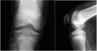 صورة توضيحية لـ التهاب العظم والغضروف السالخ وإصابات الركبة الأخرى لدى الأطفال: دليل شامل للآباء