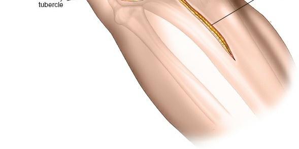 Illustration 10 for Surgical Access: Mastering the Tibia's Surface & Fibula Approaches