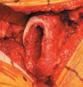 Mastering Uncemented Total Hip Arthroplasty: A Complete Guide