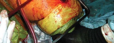 Illustration 83 for S-ROM: Inside the Technique of Modular Implant Design