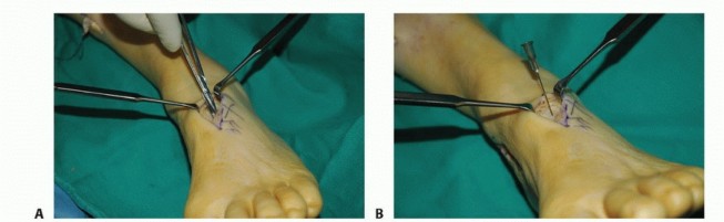 Illustration 30 for Foot Drop Surgery: How a Pin or Drill Elevates Tendon Transfer