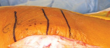 صورة طبية: استبدال مفصل الركبة بالحد الأدنى من التدخل الجراحي: ألم أقل وتعافٍ أسرع مع النهج شبه الرضفي الإنسي