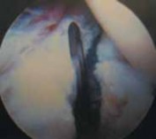 Illustration 26 for Resolving Femoral Head Neck Impingement: Arthroscopic FAI Solutions