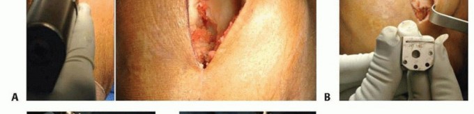 صورة توضيحية لـ استبدال مفصل الركبة الجزئي: حل متقدم لآلام الركبة المستمرة مع الأستاذ الدكتور محمد هطيف