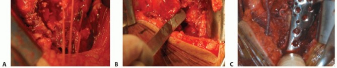 Illustration 19 for Optimizing Fixation of Proximal Humerus Fractures: A Guide