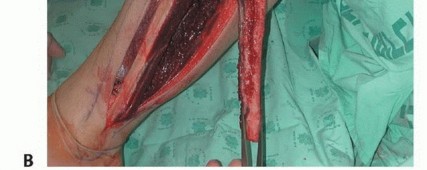 Illustration 24 for Free Vascularized Fibular Grafts: Solving Complex Bone Defects