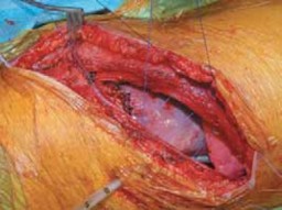 Illustration 51 for Mastering Anterior Interbody Arthrodesis with Instrumentation for Scoliosis