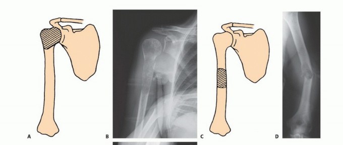 Illustration 4 for Restore Vital Function: Surgery for Type II Humeral Metastasis