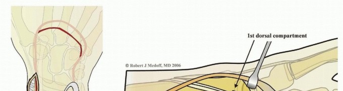 Illustration 14 for Fragment-Specific Fixation: Restore Carpal Facet Horizon