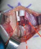 Illustration 15 for Unlocking Mobility: Distal Lengthening for Lateral Hamstring Muscle