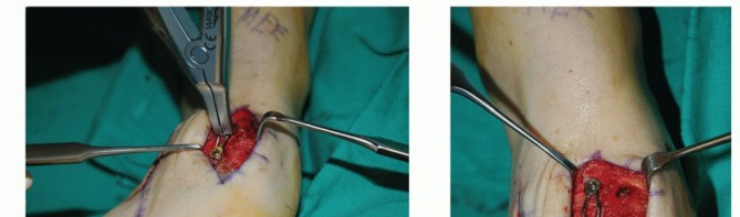 Illustration 33 for Mastering Midfoot Arthrodesis: Protect the Deep Neurovascular Bundle