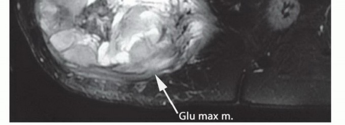 Illustration 4 for Beyond Hemipelvectomy: Preservation of the Sciatic in Buttock Surgery