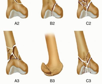 Illustration 19 for Repairing Distal Femur Fractures: Open Reduction & Internal Fixation