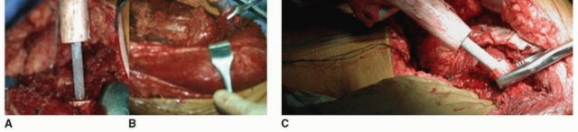 Illustration 21 for Allograft Prosthetic Composite: Mastering Proximal Femur Reconstruction